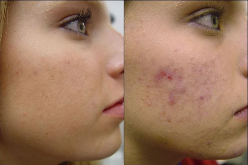 Про пінку для вмивання від прищів: причини і лікування червоних плям на шкірі обличчя