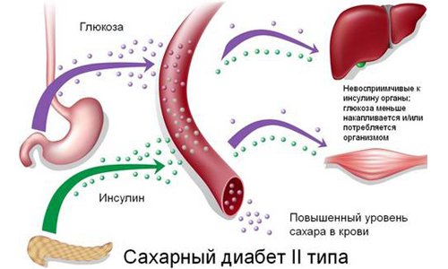 Про схуднення при діабеті 2 го типу: як харчуватися при діабеті 1 го і 2 го типу