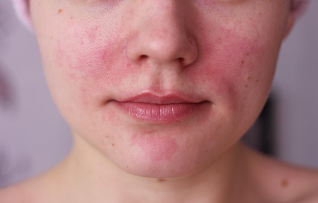 Про почервонінні і горінні шкіри обличчя: причини почервоніння і що робити
