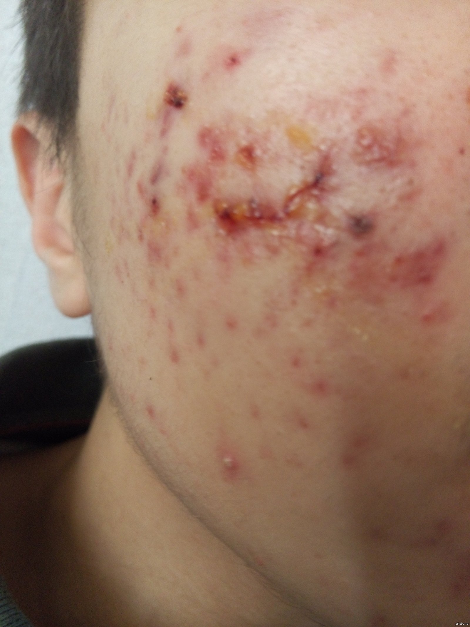 Про проблемній шкірі обличчя: лікування прищів і вугрів у домашніх умовах, що робити