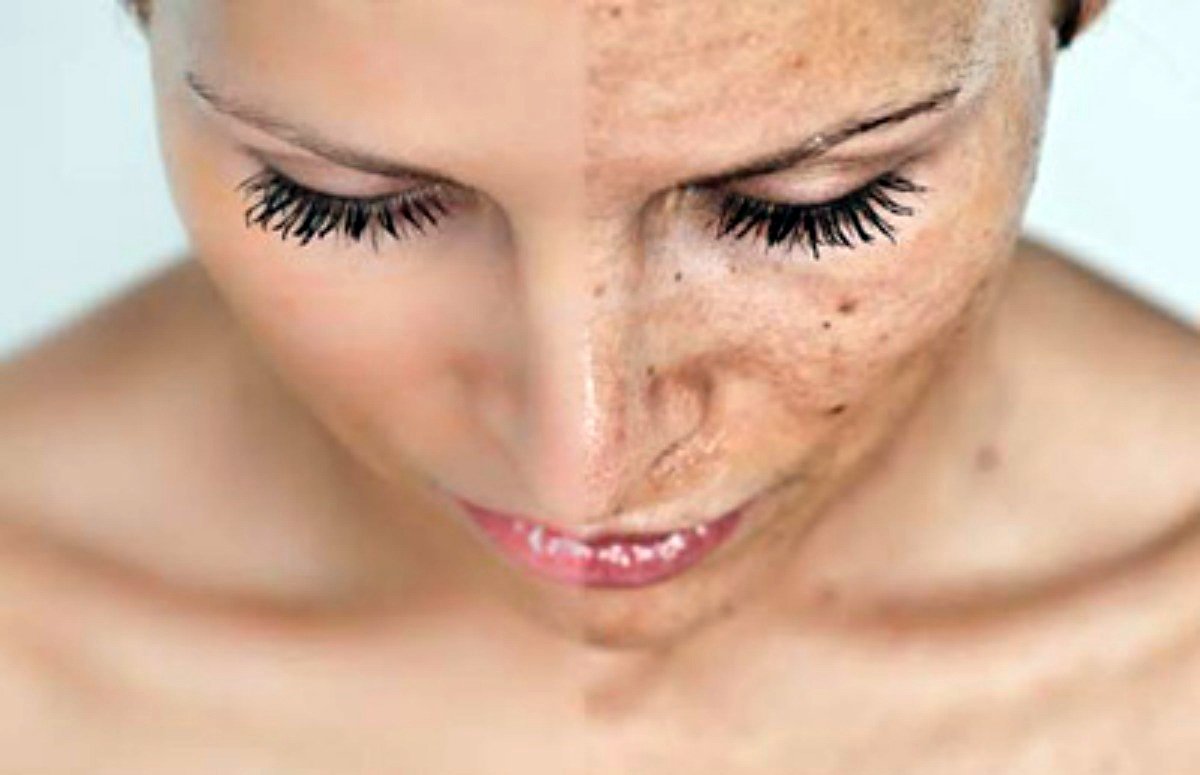 Про позбавлення від пігментації на обличчі після пологів: як прибрати пігментні плями