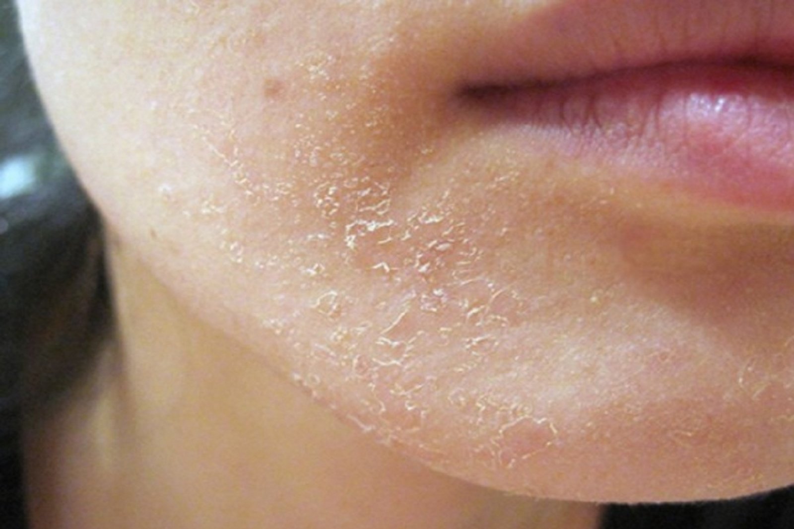 Про позбавлення від лущення шкіри на обличчі в домашніх умовах: що потрібно робити