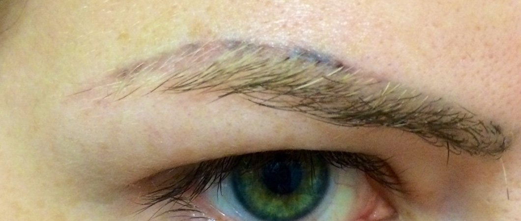 Про видалення микроблейдинга брів лазером і в домашніх умовах за допомогою йоду Про видалення микроблейдинга брів лазером і в домашніх умовах за допомогою йоду