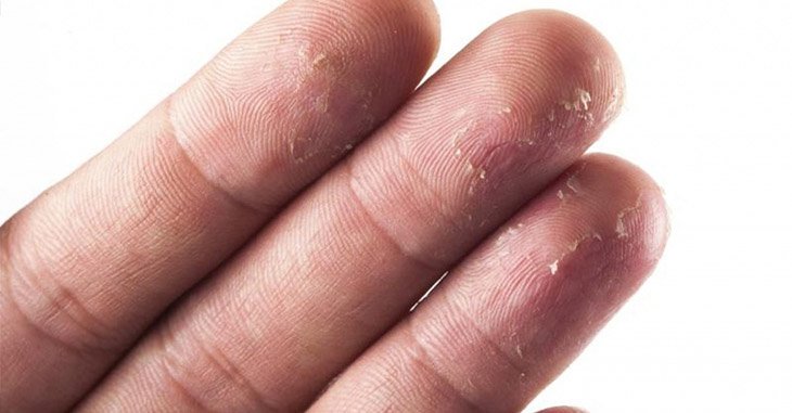 Від чого лущиться шкіра на пальцях рук