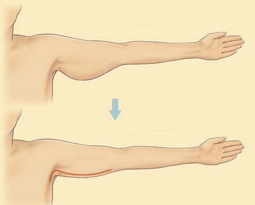 Підтягнута шкіра на руках: як позбутися від провисання шкіри після схуднення