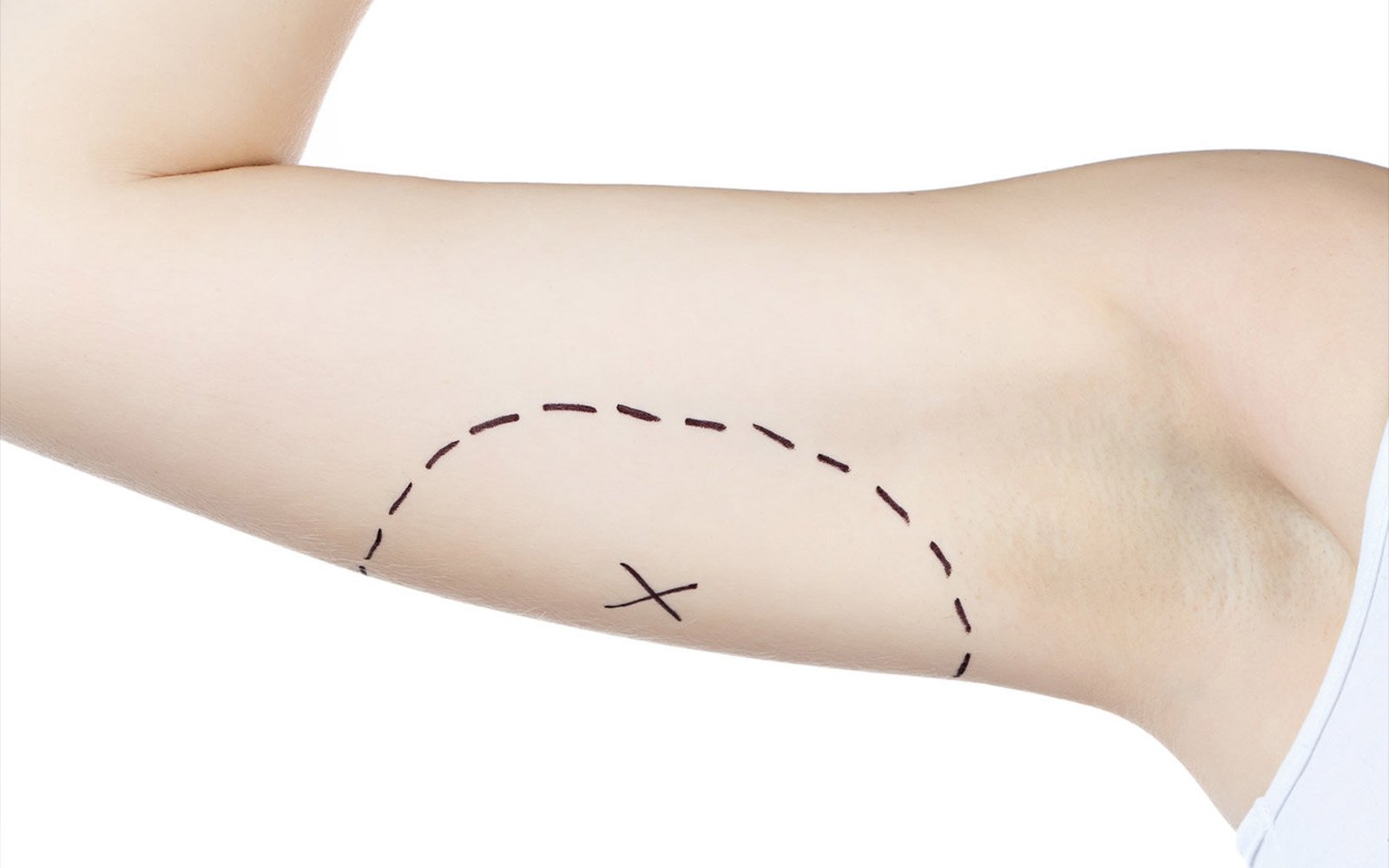 Підтягнута шкіра на руках: як позбутися від провисання шкіри після схуднення