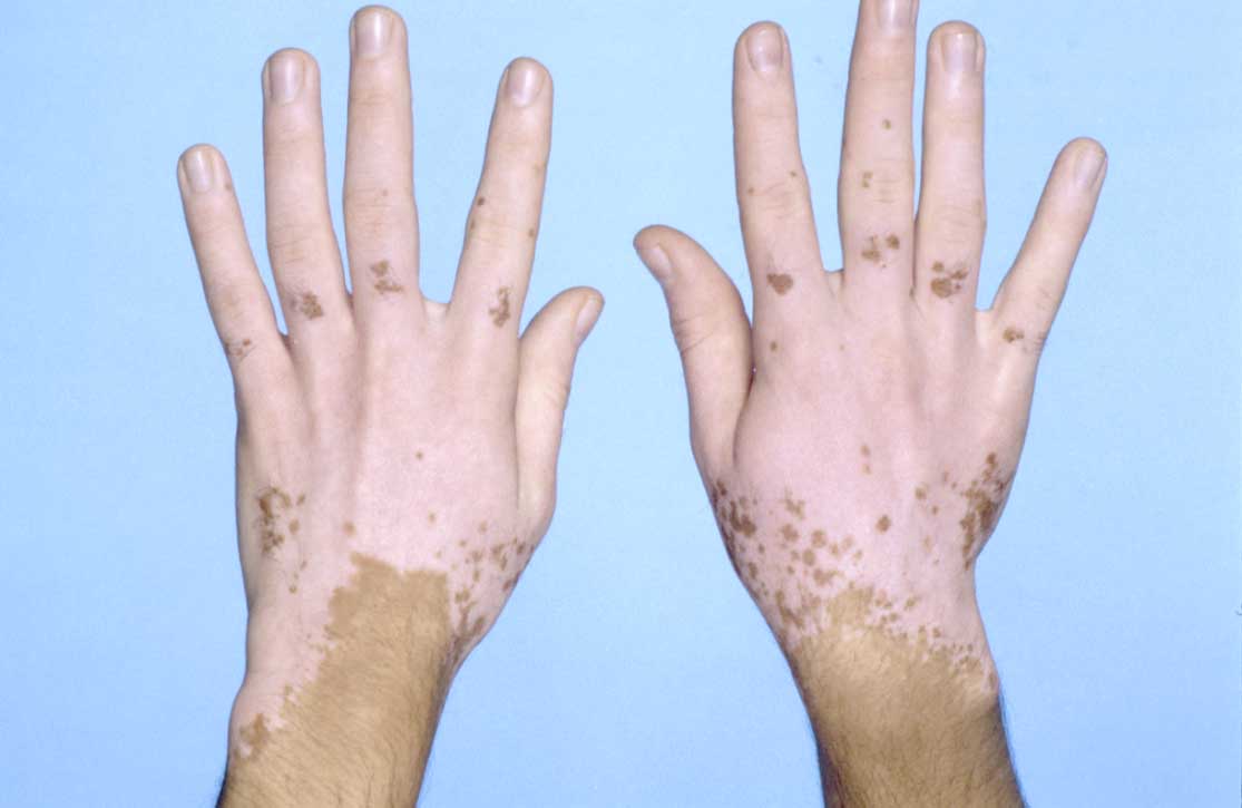 Причини пігментації на шкірі рук: білі і темні плями — що це за хвороба