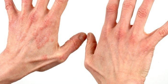 Лущення шкіри на руці, долоні і пальцях: причини і лікування роздратування