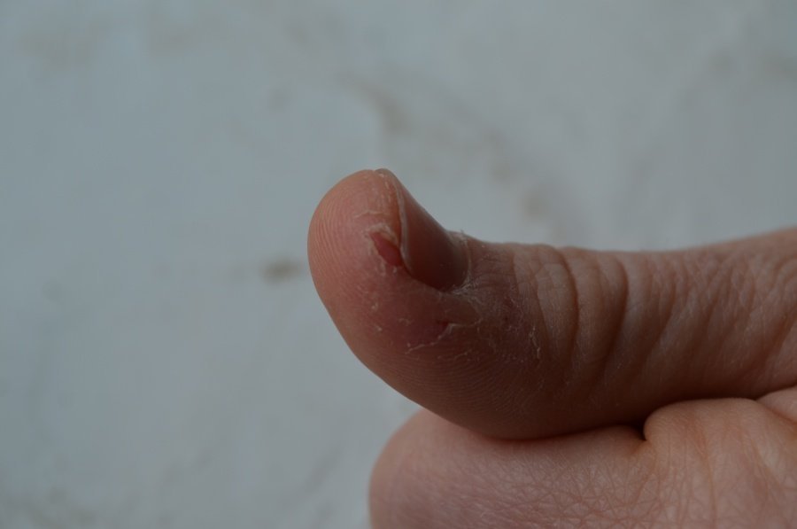 Тріскається шкіра на пальці руки близько нігтя у жінок: причини і лікування