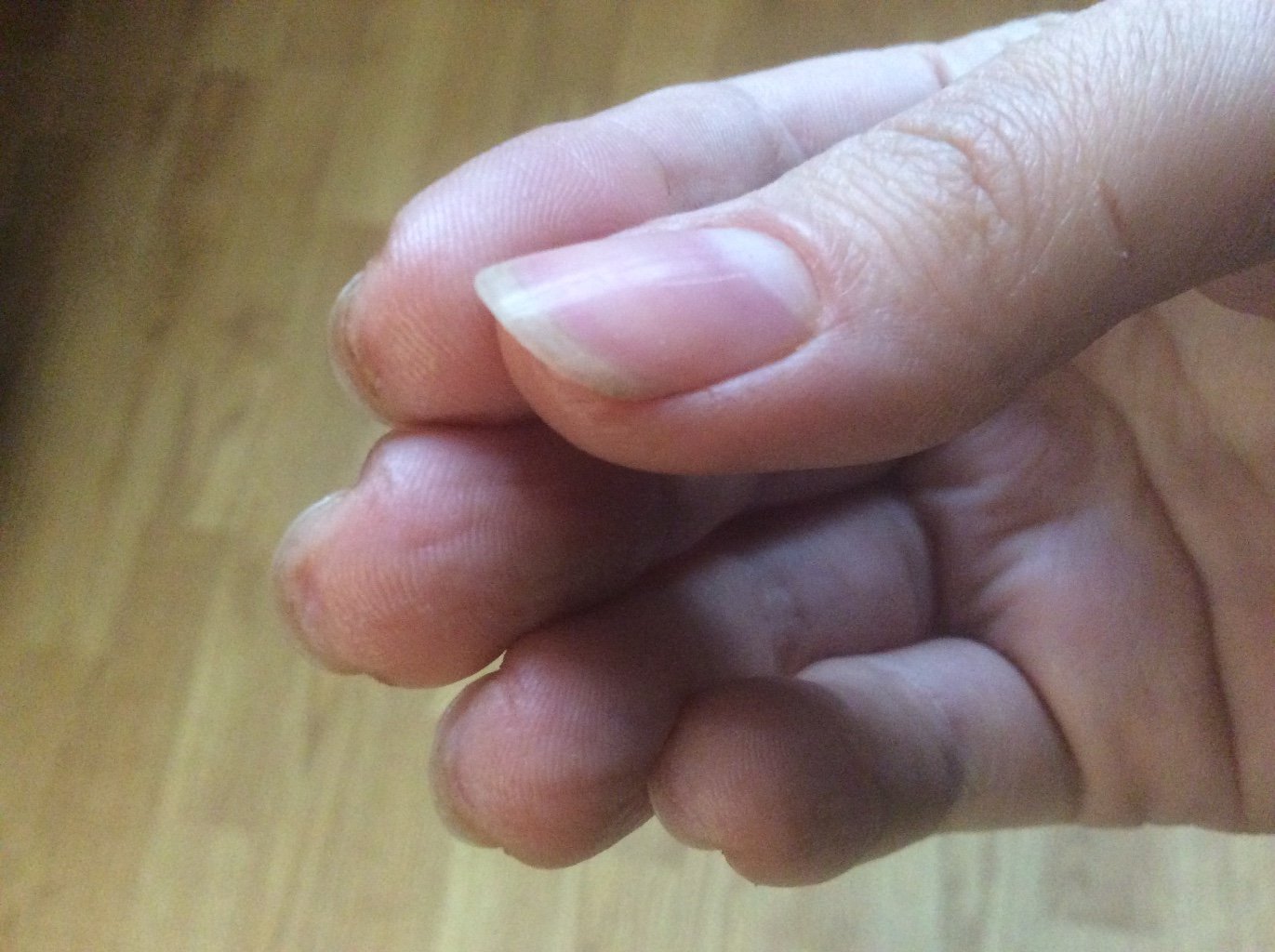 Тріскається шкіра на пальці руки близько нігтя у жінок: причини і лікування