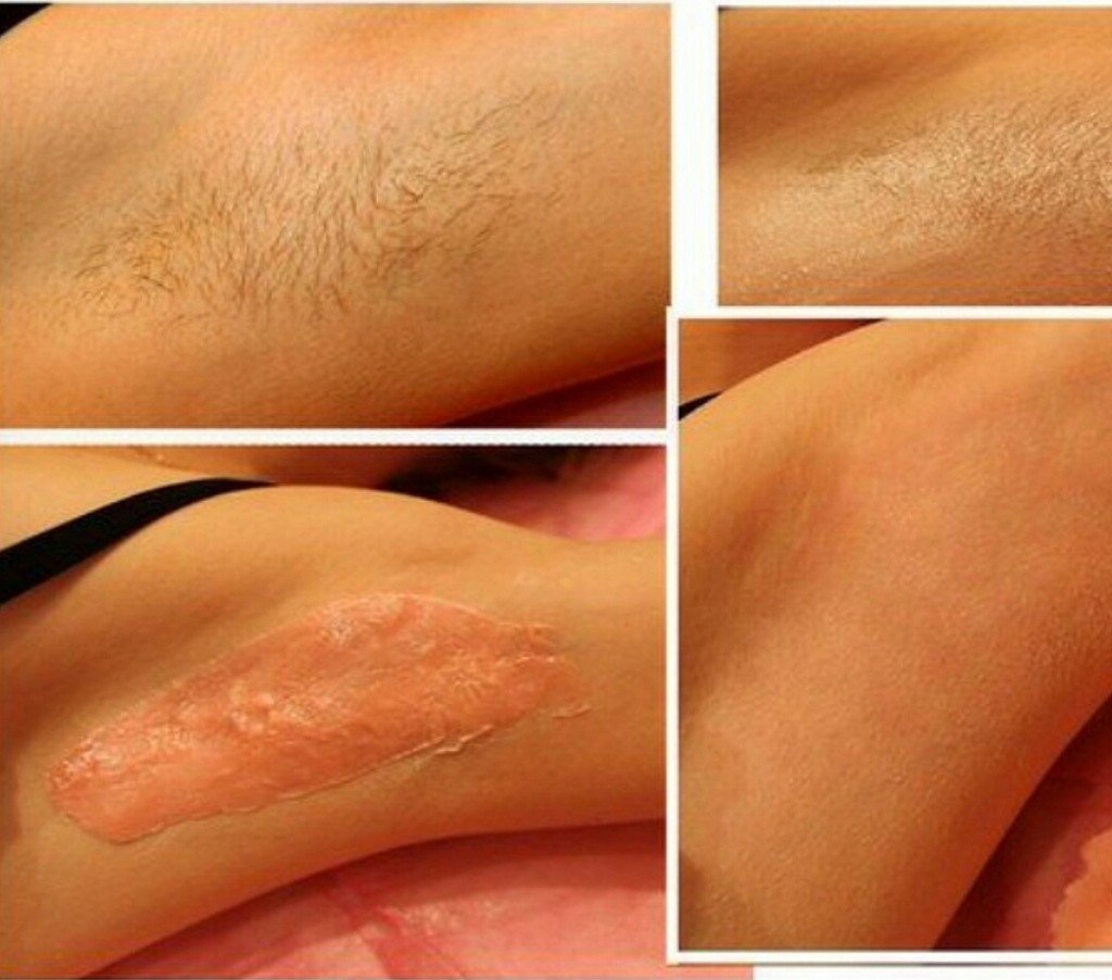 Все про догляд після шугарінга: що не можна робити, чим обробити шкіру