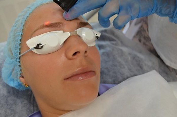 Про лазерної епіляції брів у чоловіків і жінок: видалення волосся, зведення лазером