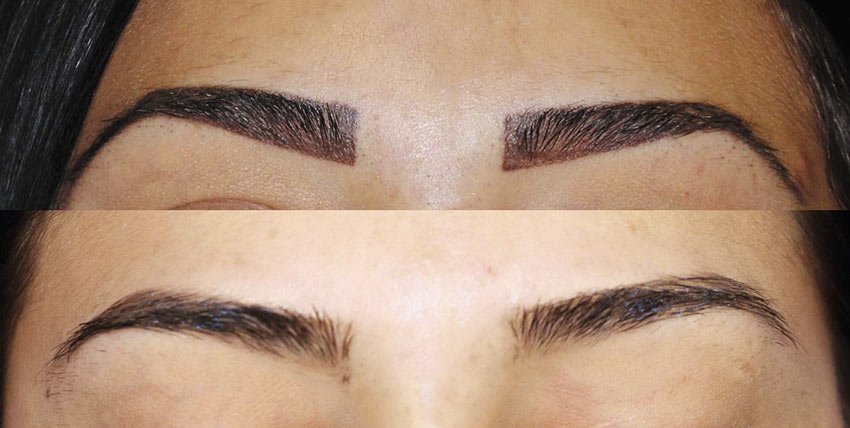 Про лазерної епіляції брів у чоловіків і жінок: видалення волосся, зведення лазером