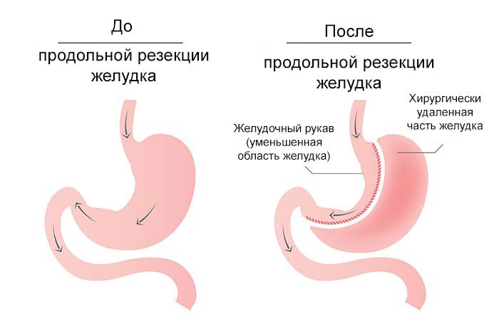 Про резекції шлунка для схуднення: як зменшити шлунок, щоб схуднути
