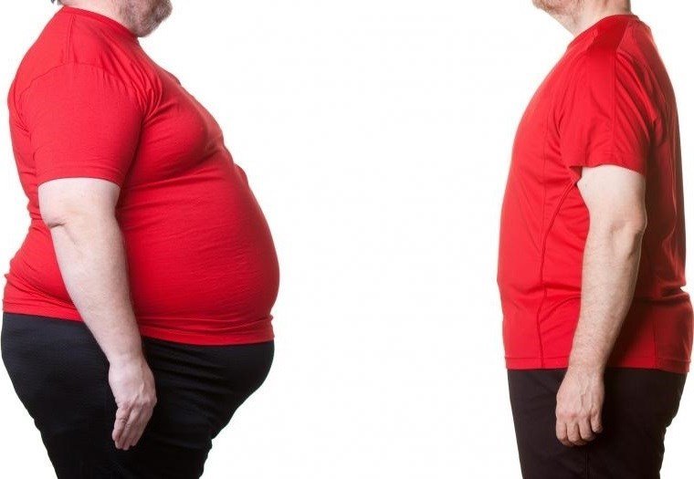Про резекції шлунка для схуднення: як зменшити шлунок, щоб схуднути