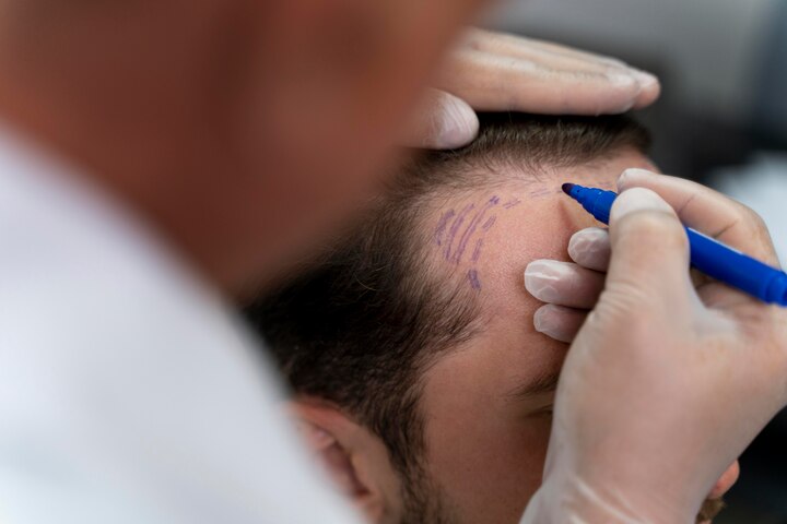Типи пересадки волосся: детальний огляд методів та їх особливостей